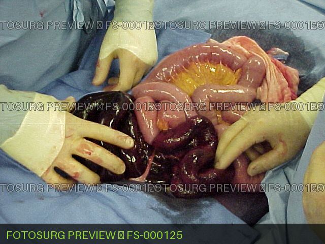 Internal hernia with Bowel Ischemia