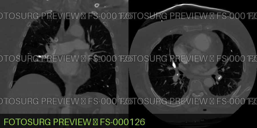 Kyphoplasty Cement Embolism 