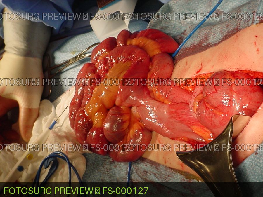 Intestinal Malrotation ( Adult)