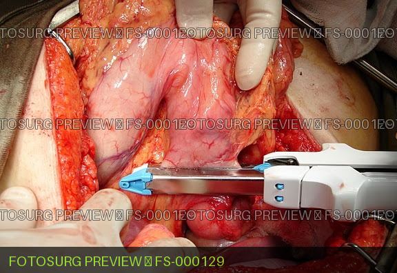 Gastrectomy