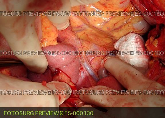 Inferior Mesenteric Vein