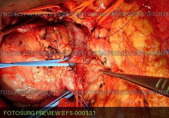 Whipple (Vascular isolation)
