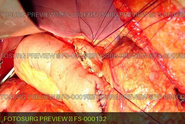 Whipple ( Preparation for Pancreaticojejunostomy)