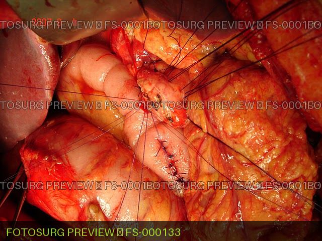 Pancreaticojejunostomy