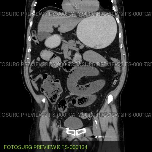 Small Bowel Feculization