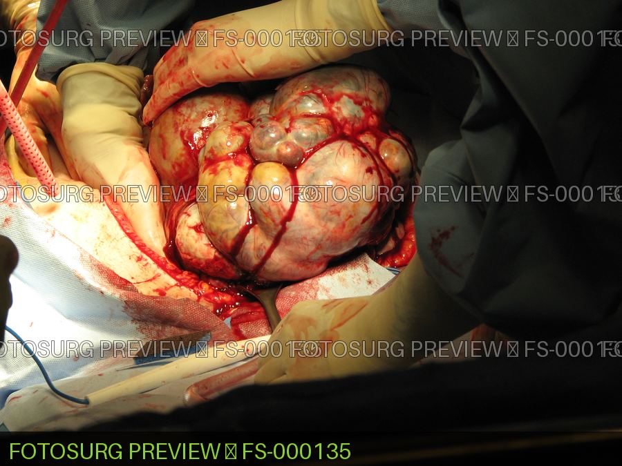 Large Ovarian Tumor