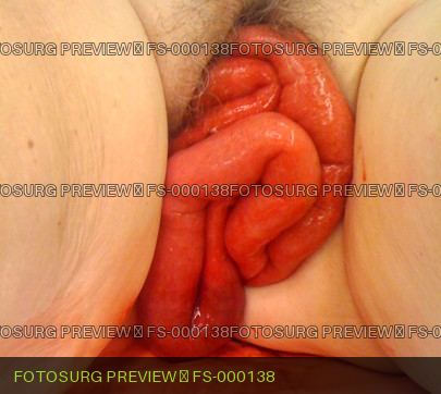 Vaginal cuff dehiscence with small bowel evisceration