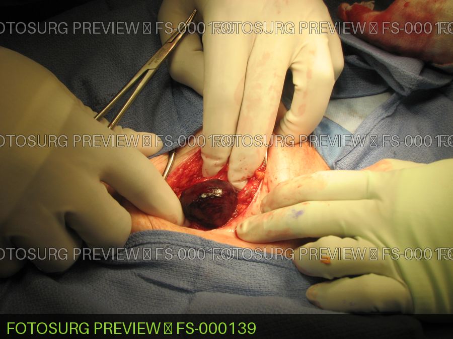 Strangulated Femoral Hernia