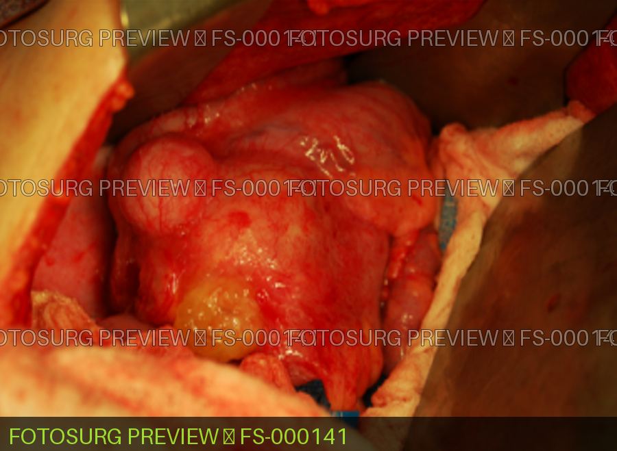 Mucus from Mucocele