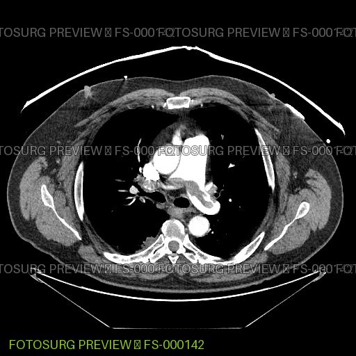 Saddle Pulmonary Embolism