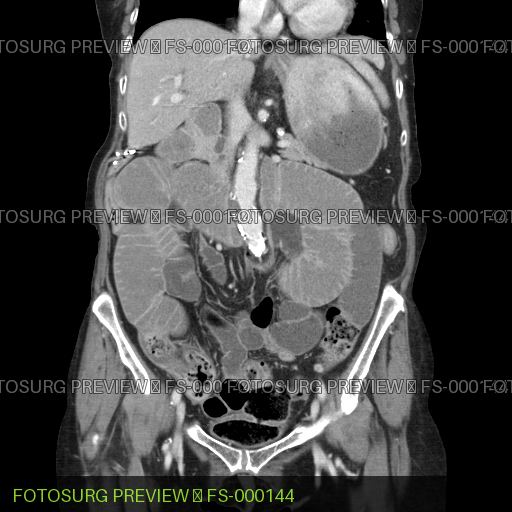 Pneumaturia