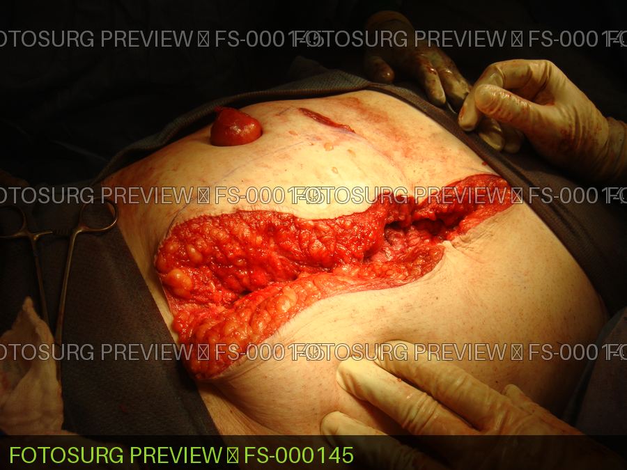 Ileostomy