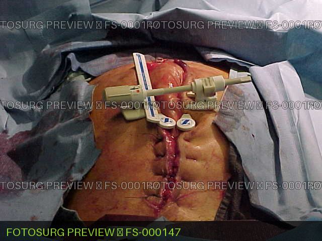 SureClosure Device Open Abdomen