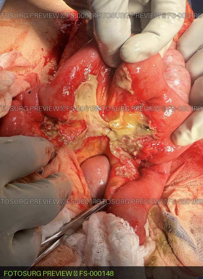 Small Bowel Interloop Abscess