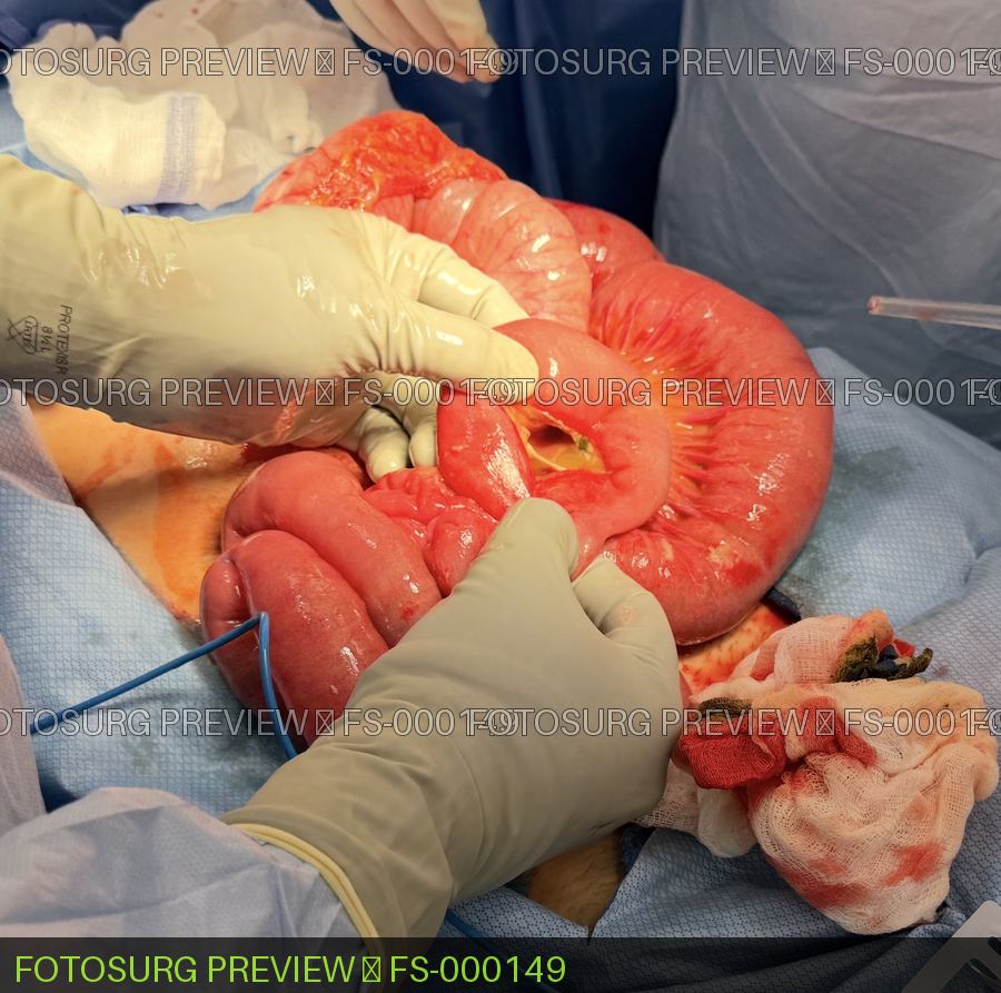 Small Bowel Perforation