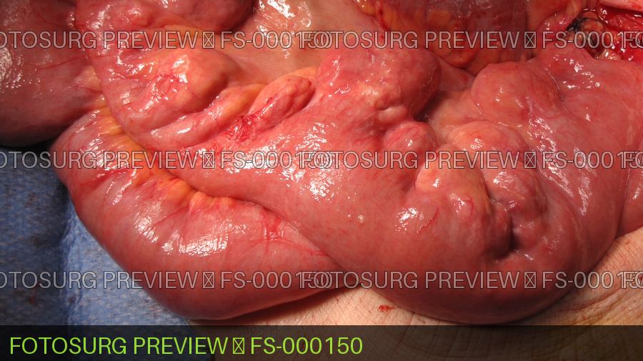 Small Bowel Diverticulum