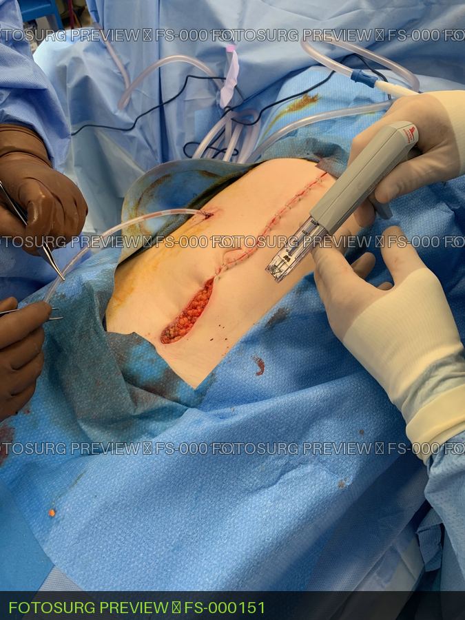 Midline Closure