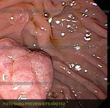 Duodenal mass