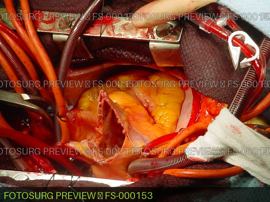 Atriotomy